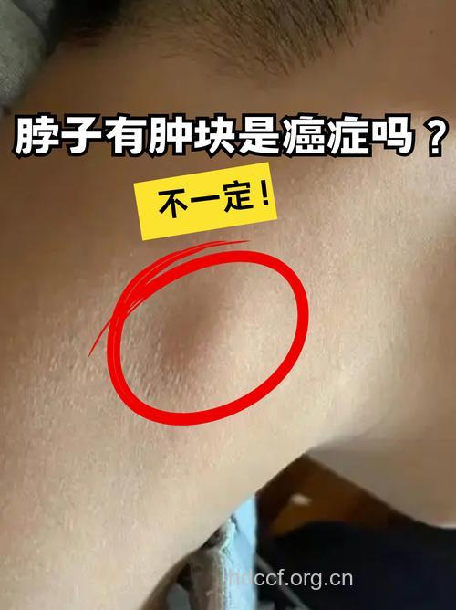 颈部摸到肿块,小心甲状腺癌