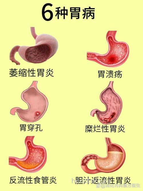 什么是急性糜烂性胃炎?