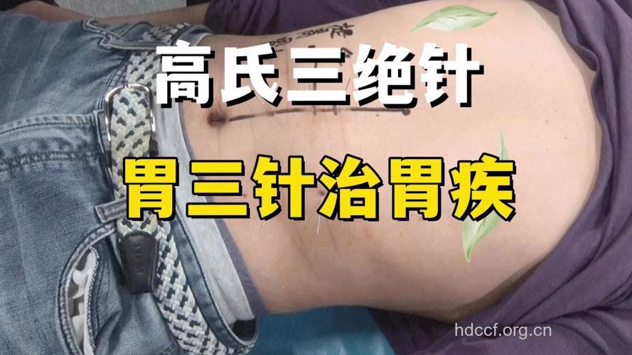 中医针刺法治疗慢性胃炎