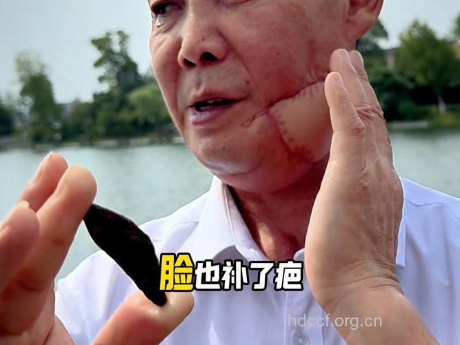 嚼槟榔诱发口腔癌?