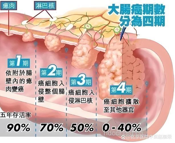 结直肠癌症状和防治