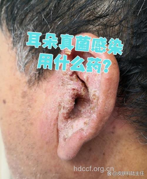 警惕:滥用消炎药 耳朵也长霉