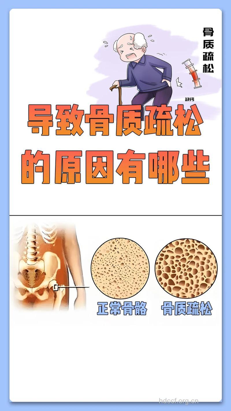 生活中促使骨质疏松的因素有哪些