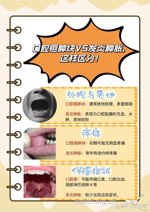 如何通过自查辨别口腔溃疡是否是口腔癌