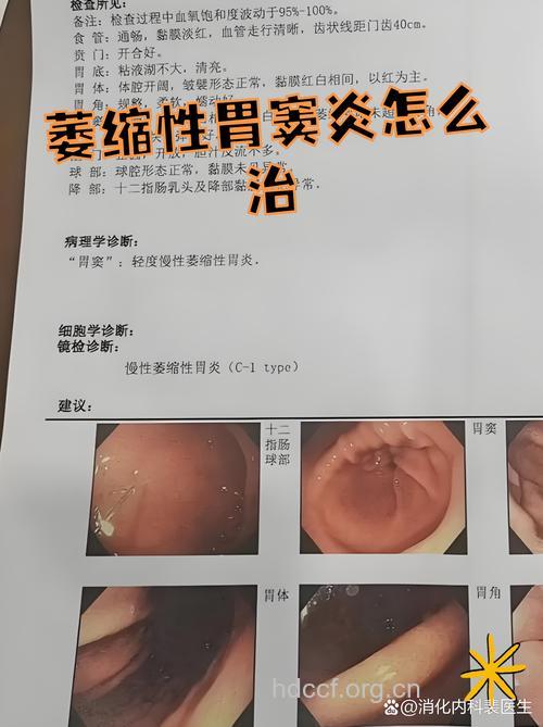 萎缩性胃窦炎有哪些治疗方法