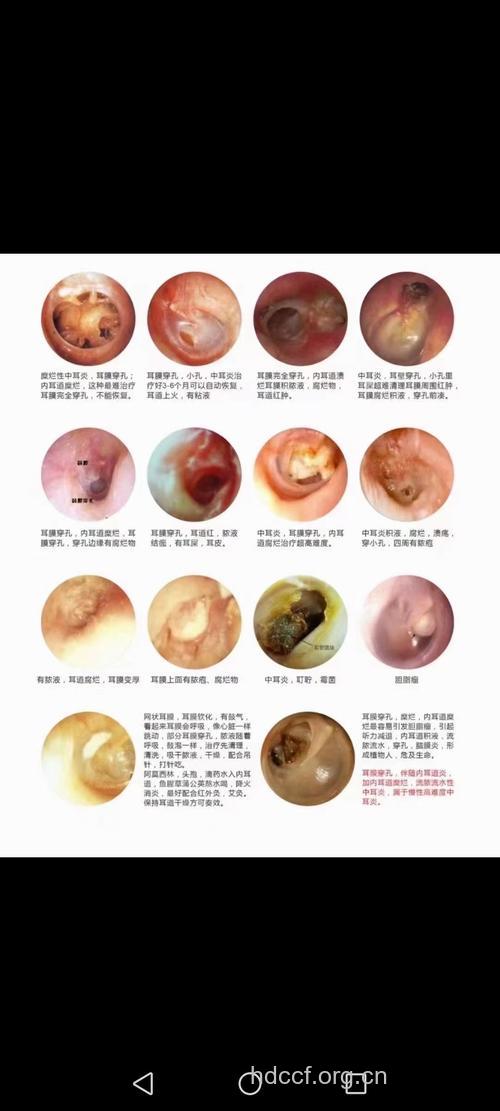慢性化脓性中耳炎的症状有哪些