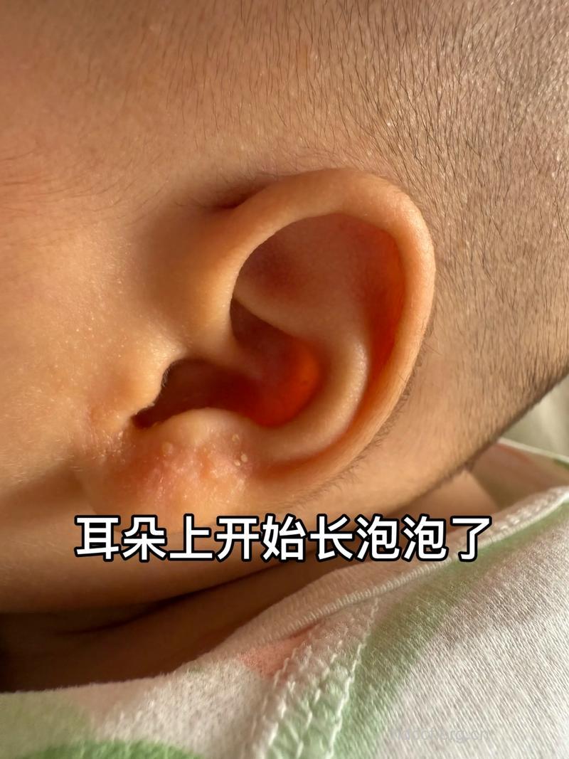怎么治疗婴幼儿外耳湿疹方法