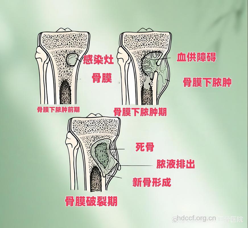 怎么治疗骨膜下脓肿