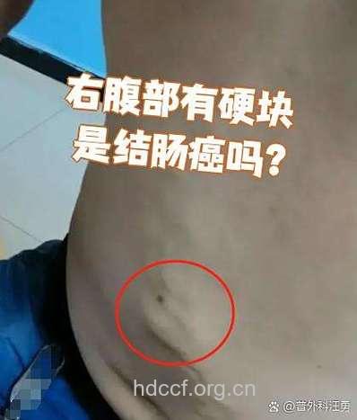 腹部包块是大肠癌早期信号
