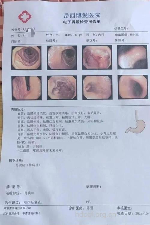 哪些检查可发现早期胃癌