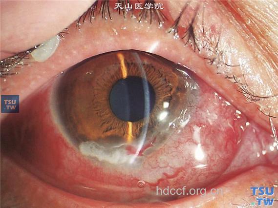 什么是Mooren溃疡？