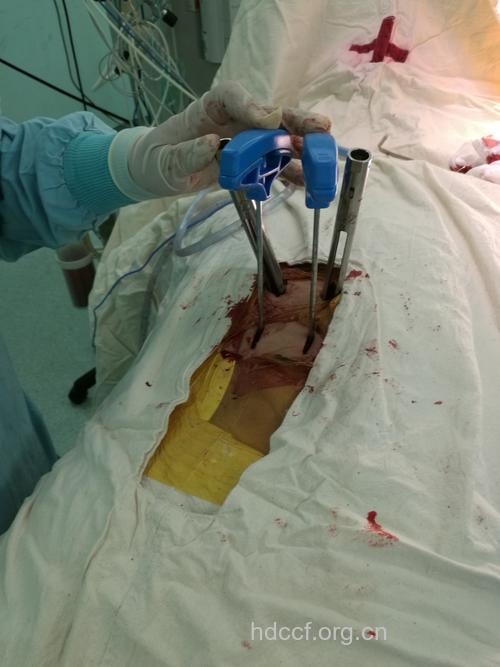 骨质疏松性骨折的手术治疗