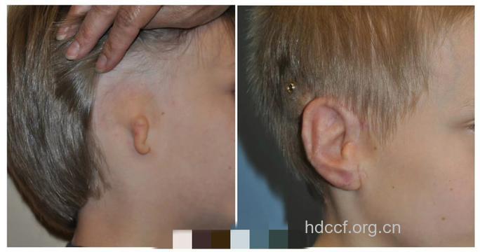 耳郭再造是怎么回事