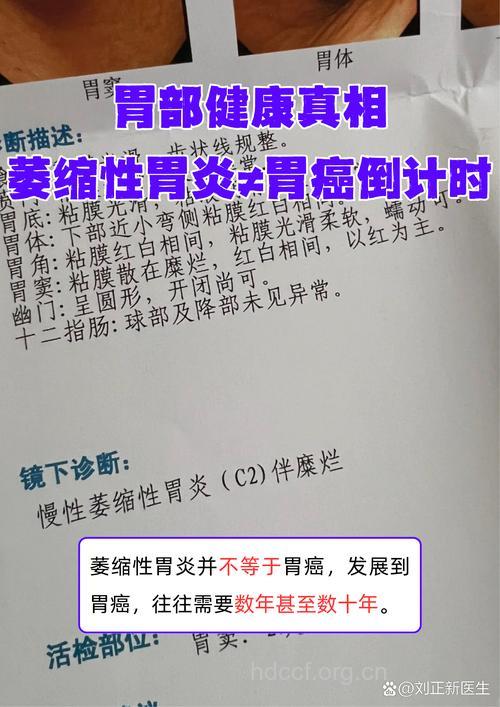 萎缩性胃炎并不完全是胃癌