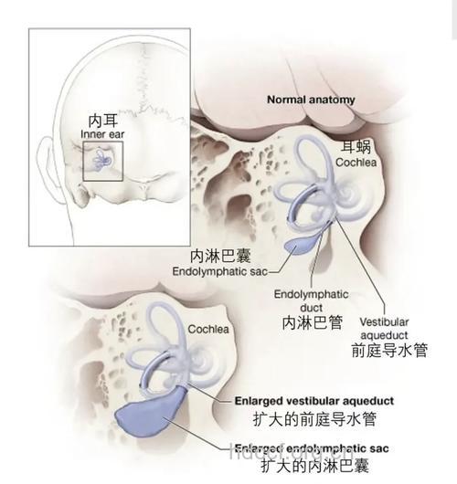 突然不说话原来是前庭导水管综合症