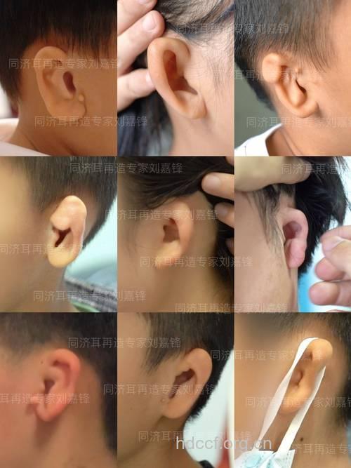 先天性耳畸形的类型