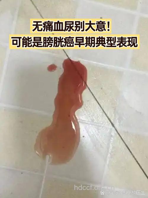 无痛血尿膀胱癌的先兆