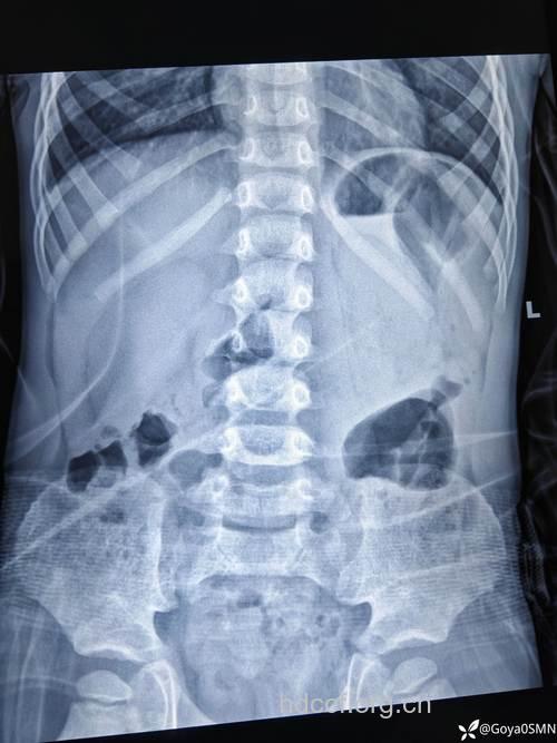 慢性胃炎可以X线检查吗？