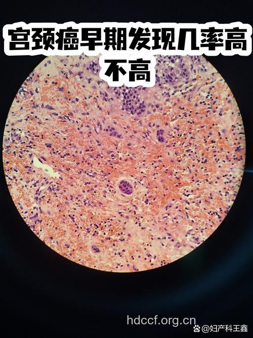 发现妇科肿瘤的蛛丝马迹