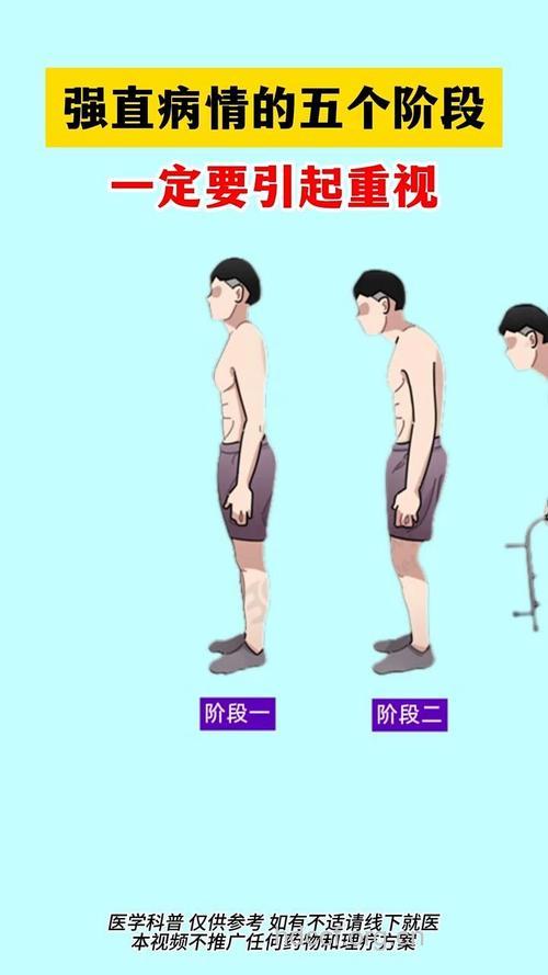强直性脊柱炎初期症状