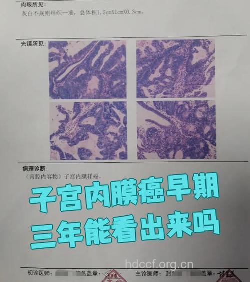 早期子宫内膜癌有迹可寻