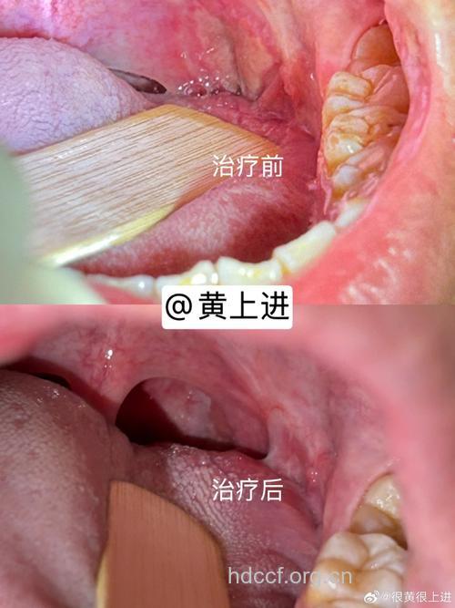 扁桃体癌原来是口交惹得祸！