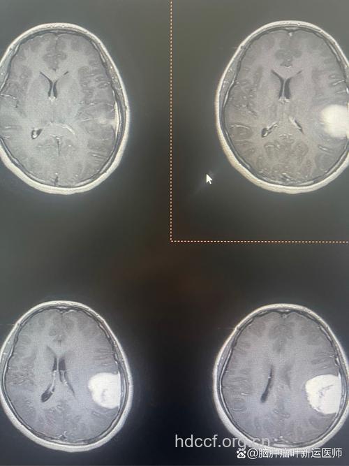 脑肿瘤信号：清晨头痛
