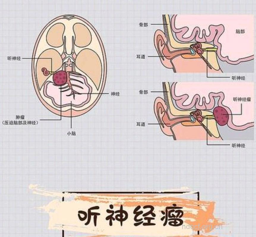 警惕!听神经瘤的早期信号
