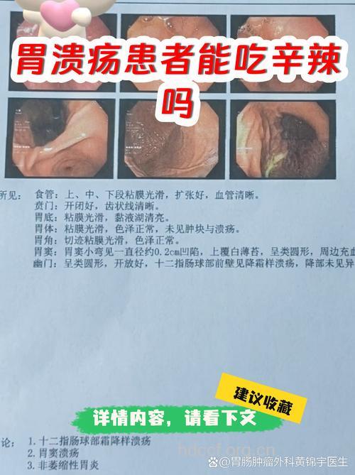 胃溃疡可以吃辣椒吗