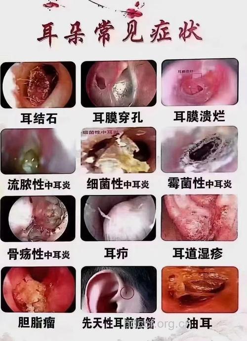 夏天谨防霉菌性外耳道炎