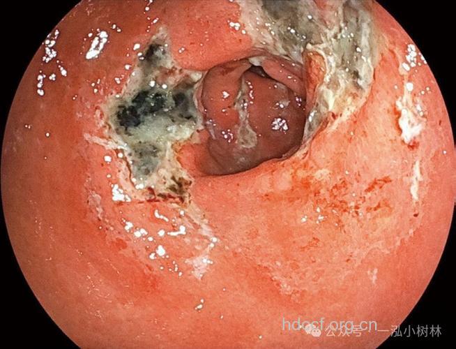 胃溃疡的症状有哪些