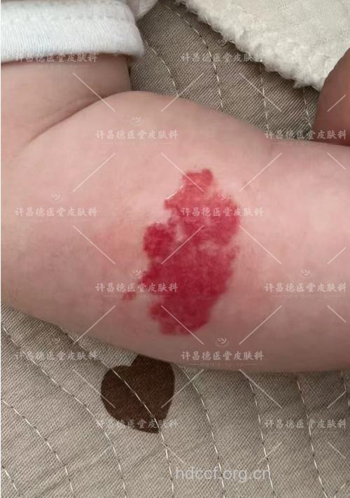 儿童经常腿疼要小心血管瘤