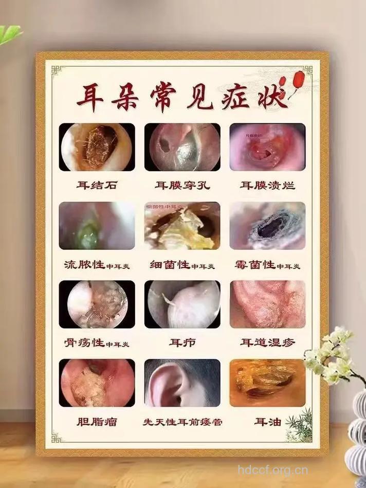 是什么引起粘连性中耳炎及其症状