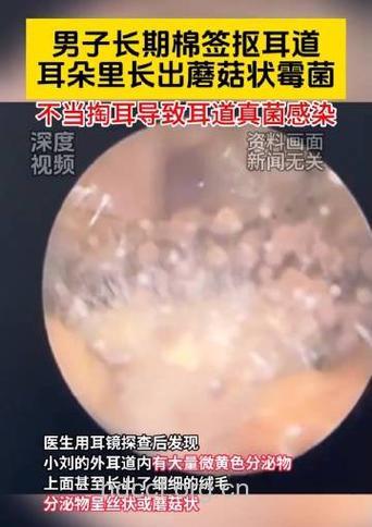 慢性咳嗽或为耳屎惹祸