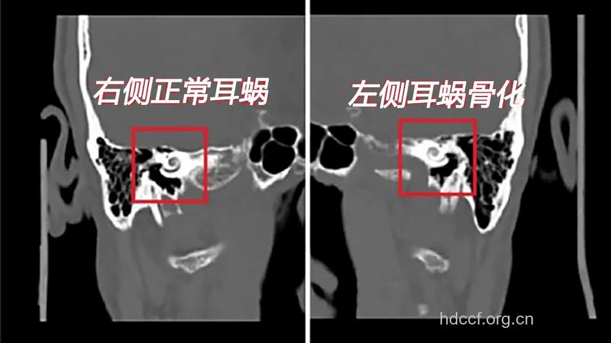 乳突、鼓室、耳硬化症的区别