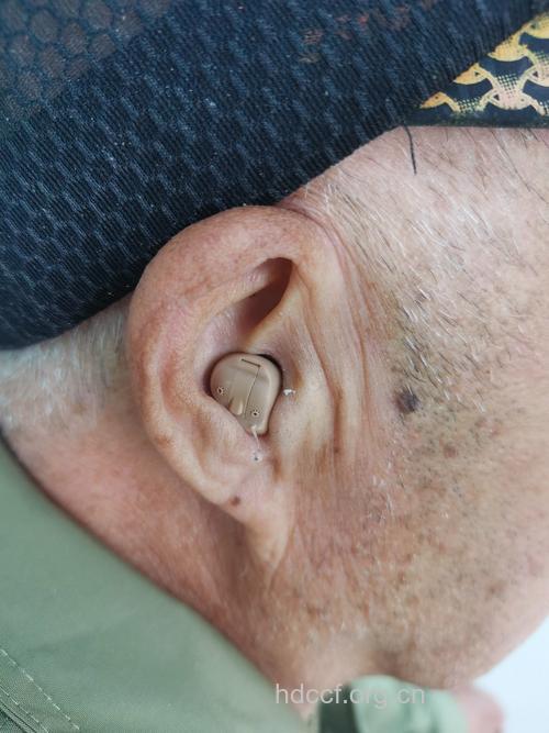 医用棉球忘在耳道至患者失去听力