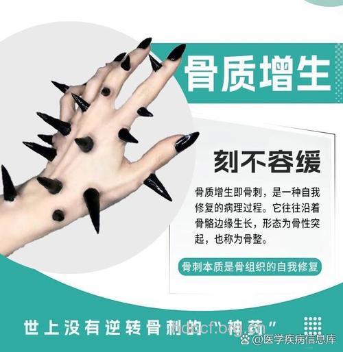 哪些非手术方法治疗骨质增生