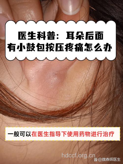 解析耳后骨膜下脓肿的临床表现及治疗方法