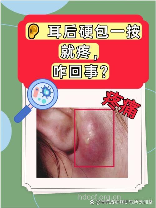 解析:耳后骨膜下脓肿的症状及治疗