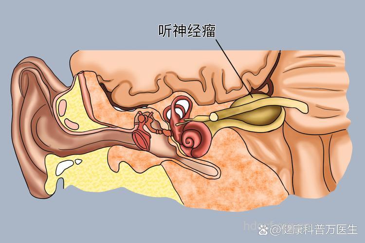 经常使用手机易患听神经瘤