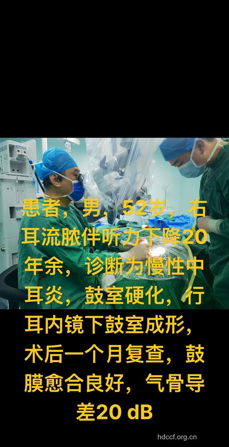 手术法有效治疗鼓室硬化症