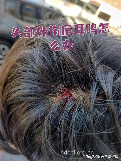 头部外伤伴有耳鸣者应就医