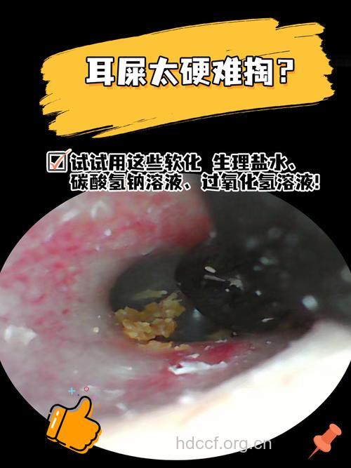 耵聍软化剂会伤害耳朵吗？