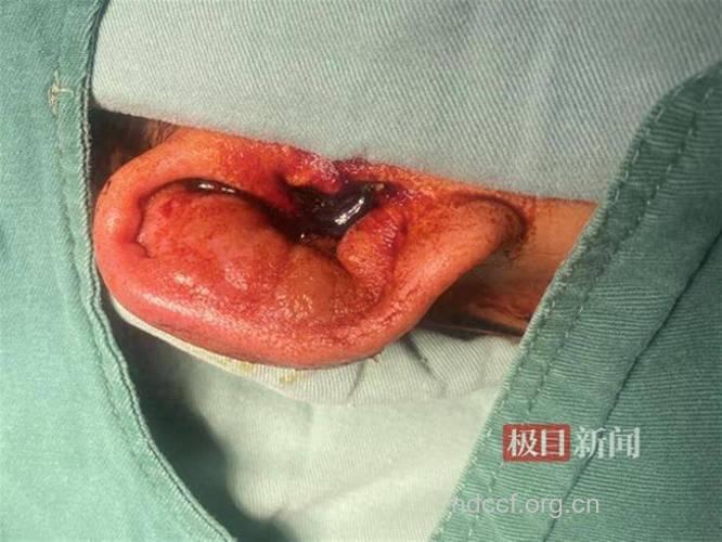 专家:在软骨上打耳洞易发炎