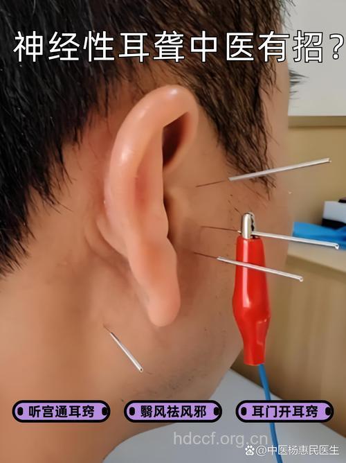 治疗耳鸣最有的效的方法--针灸