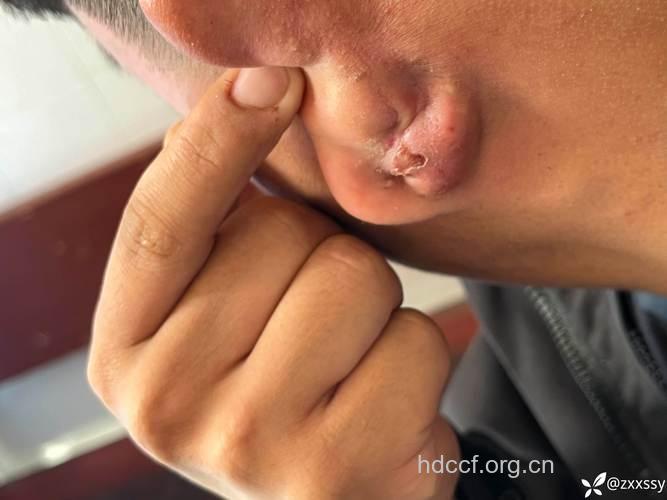 耳廓软骨膜炎感染化脓后有哪些临床表现?