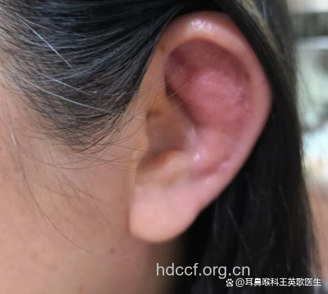 耳廓软骨膜炎的典型症状