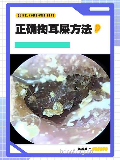 掏耳屎要小心感音性耳聋