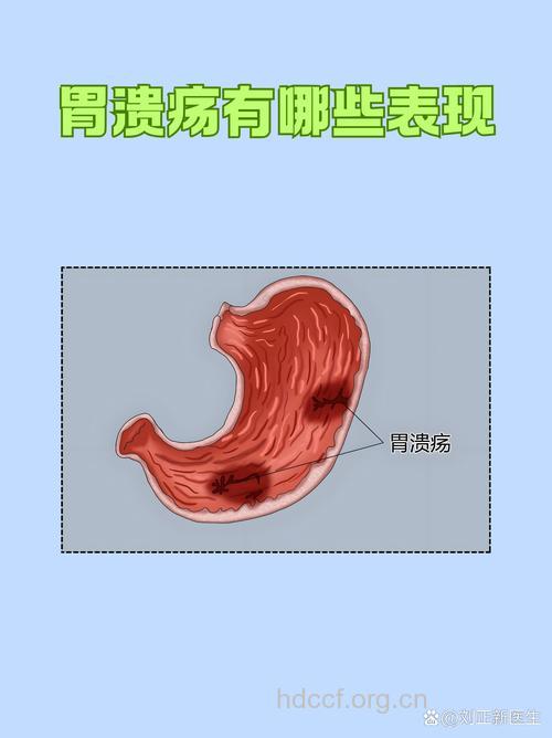 疾病百科 一起看看胃溃疡是什么