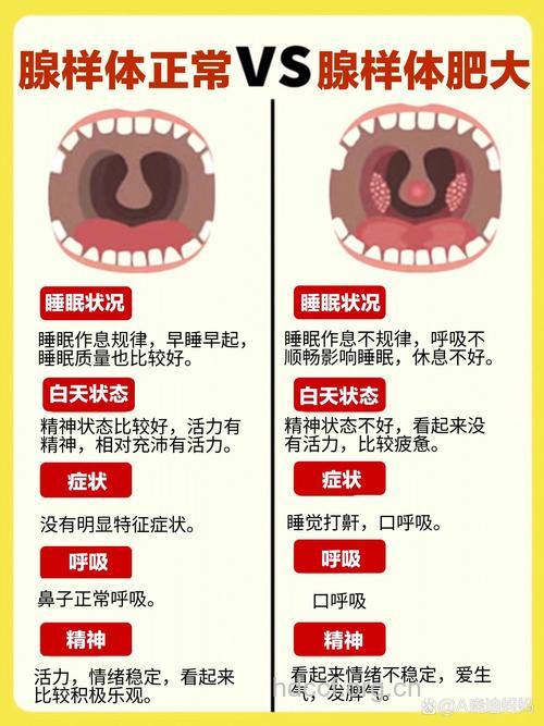 小儿腺样体肥大的症状 分局部和全身症状